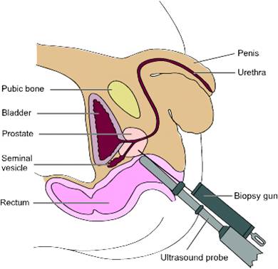 Transrectal Ultrasound of Prostate and Biopsy
