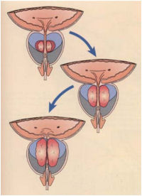 Benign prostatic hypertrophy(BPH)