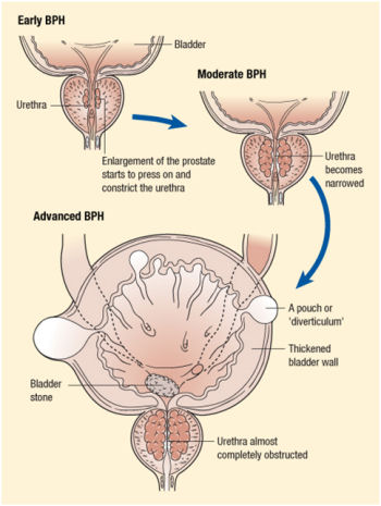 Benign prostatic hypertrophy(BPH)