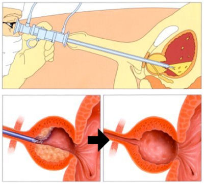 Trans-urethral resection of the prostate